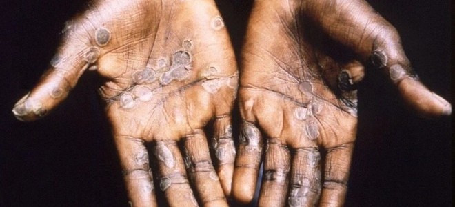 DSÖ, küresel acil durum ilan etti: Maymun çiçeği virüsü nedir?