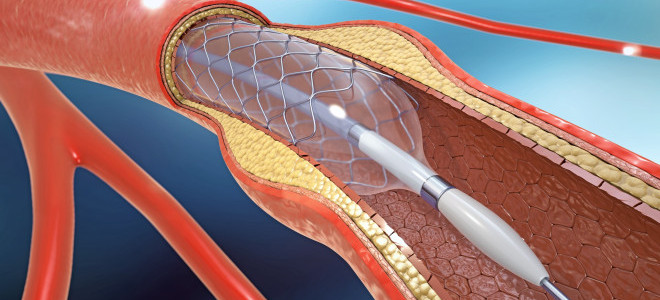 Kalp damar hastalıklarında ilaçlı balon dönemi