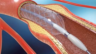 Kalp damar hastalıklarında ilaçlı balon dönemi